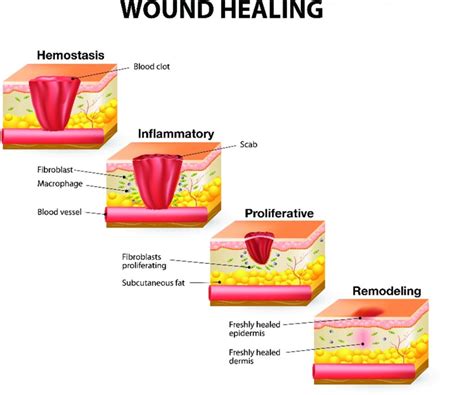 Il Processo Di Guarigione Delle Ferite Nurse Times