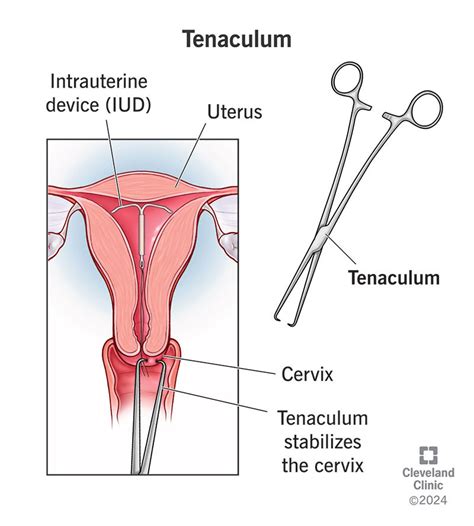 Tenaculum: Gynecology, Forceps, Use, Pain & Alternatives