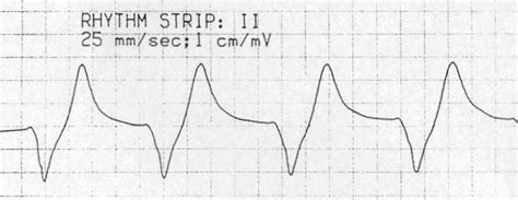 Sine Wave In Ecg