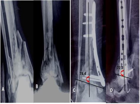 42 Years Old Female With Ao Type 43c2 Pilon Fracture A Preoperative