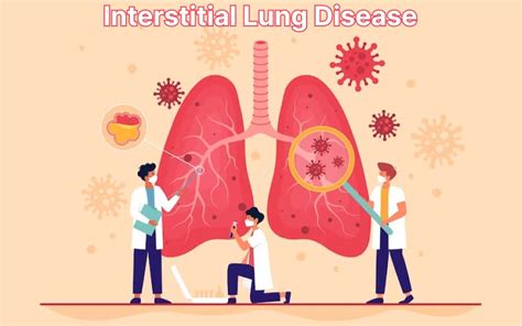 Everything To Know About Interstitial Lung Disease By Drsheetusingh Medium