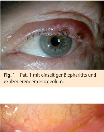 Figure From Tularemia As A Rare Cause Of Parinaud S Oculoglandular