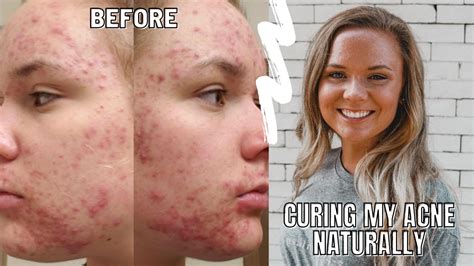 How I Healed My Cystichormonal Acne Naturally My Story No Accutane Post Birth Control