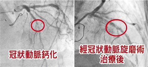 血管鈣化血壓低 「冠狀動脈旋磨術」清血路 自由健康網