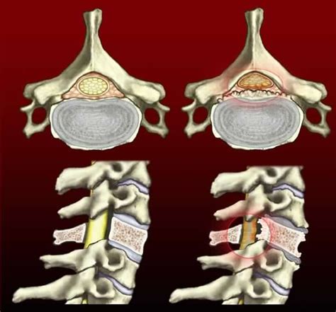 Estenorraquis O Estrechez En La Columna Vertebral WeDoMed Dolor