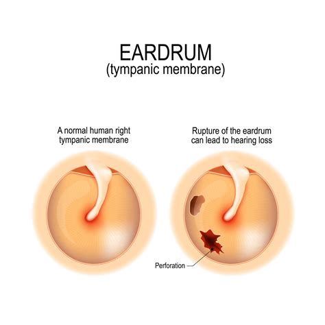 What Causes Your Eardrum to Rupture? | Annapolis and Severna Park, MD