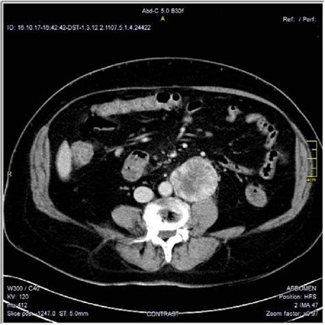 Contrast Enhanced Axial Ct Images Soft Tissue Window Show Well Defined