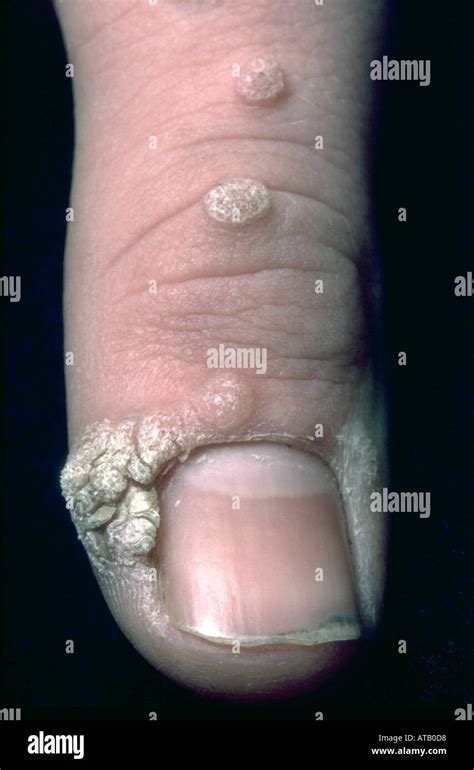 Warts On The Thumb Stock Photo Alamy