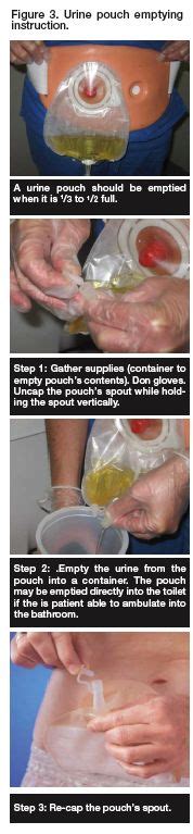 Urine Pouch Emptying Instructions Ostomy Care Ostomy Care