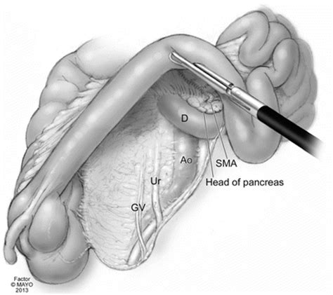 Total Abdominal Colectomy