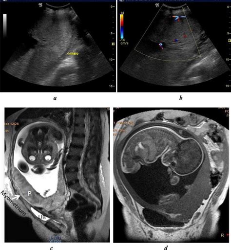 Placenta Previa Complete Centralis Showing No Features Of Invasion