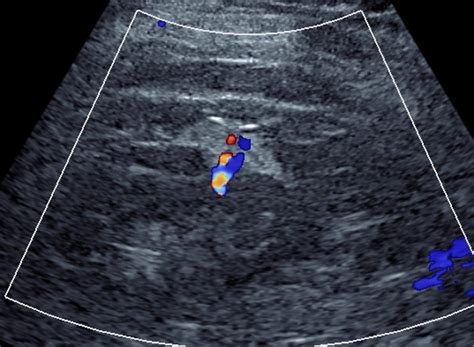 Exophytic Renal Angiomyolipoma Image