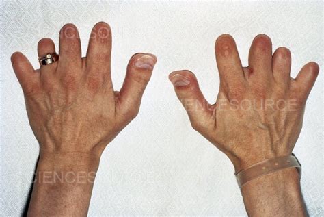 Brachydactyly Congenital Deformity Of Stock Image Science Source