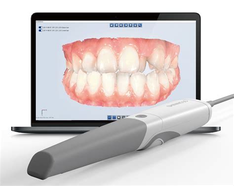 Shining 3ds Aoralscan 3 Intraoral Scanner Loaded With New Features