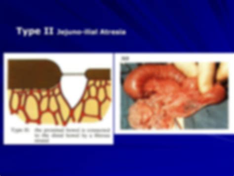 SOLUTION Lec 21 Part2 Jejunoilial Atresia Malrotation Volvulus Studypool