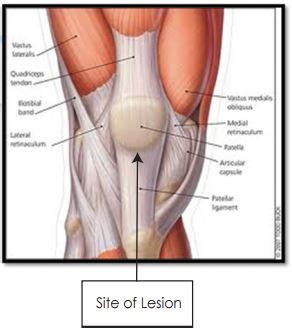 Sinding Larsen Johansson Syndrome