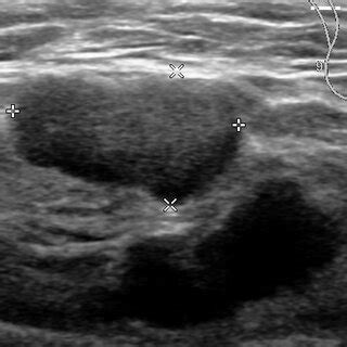 Ultrasound examination showed an enlarged axillary lymph node ...