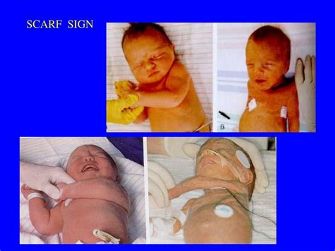 Ppt Same Gestational Age Sga Aga Lga Powerpoint Presentation Free