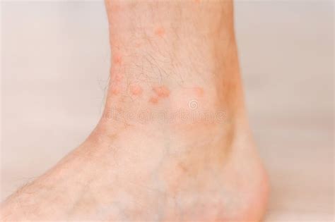 Close Up Allergic Rash Dermatitis Eczema On Man Foot Leg With Red Rash