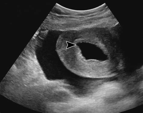 Beyond Ultrasound Ct And Mri Of Ectopic Pregnancy Ajr