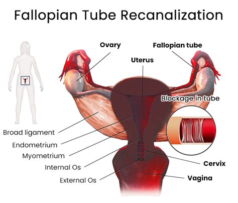 Fallopian Tube Recanalization Near Me in Brooklyn | Downtown Vein ...