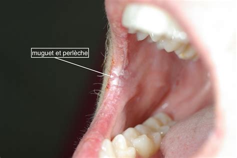 Toque Unos Pocos Sentimiento De Culpa Candida Albicans Bouche