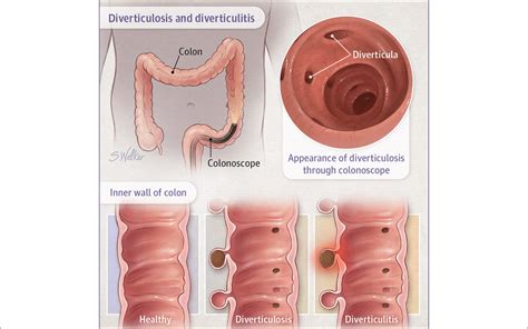 Diverticulosis and Diverticulitis – Evergreen Family Health