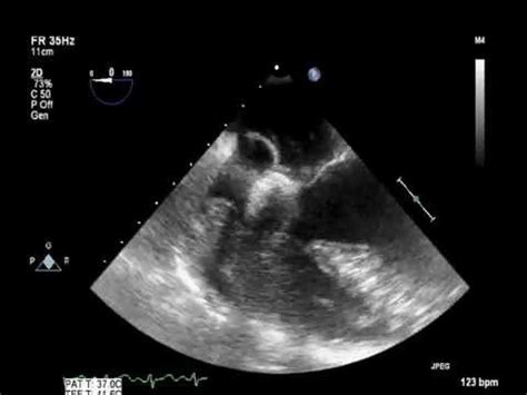 Atrial Septal Defect Transesophageal Echocardiogram