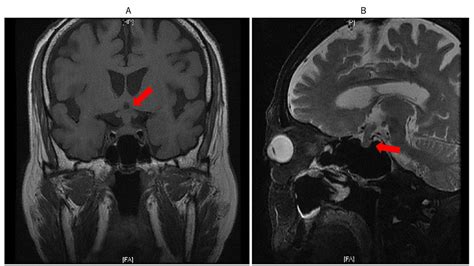 Brain MRI on June 2. A: Coronal section. B: Sagittal section. Note the ...