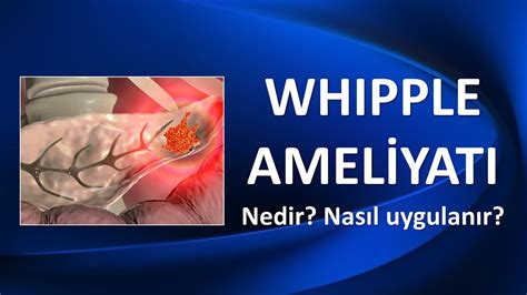 Whipple Amel Yati Ned R Youtube