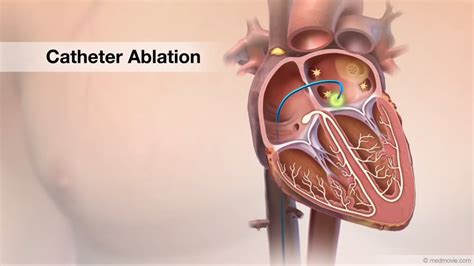 RADIOFREQUENCY RF CATHETER ABLATION Dr Karthigesan