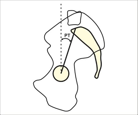 Scielo Brasil Spinopelvic Sagittal Balance What Does The Radiologist Need To Know