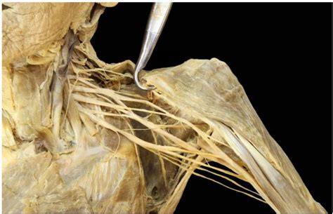 Upper Limb Brachial Plexus And Peripheral Nerves Diagram Quizlet