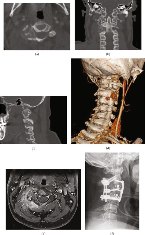 Figure 1 From Patient Matched 3 D Printed Guides For The Insertion Of