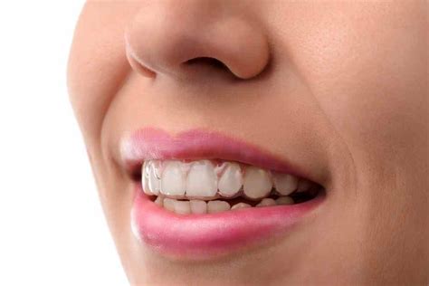 Aparatos dentales invisibles qué son y cuál escoger Estudi Dental