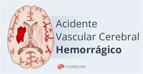 acidente vascular hemorragico cid retoedu