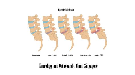 Spondylolisthesis Grades