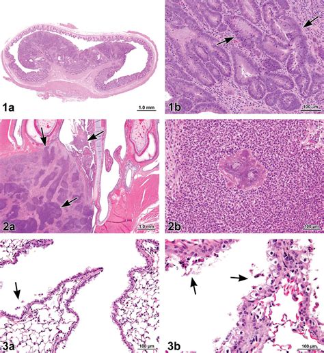 A Polypoid Adenoma In The Large Intestine Rectum Of A Female Download Scientific Diagram