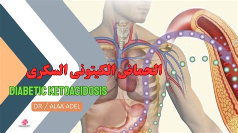 التعامل مع الحماض الكيتوني السكرى في قسم الطوارئ Diabetic