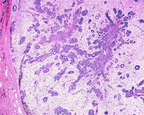 Sclerosing Adenosis Of Human Breast Photograph By Jose Calvo Science