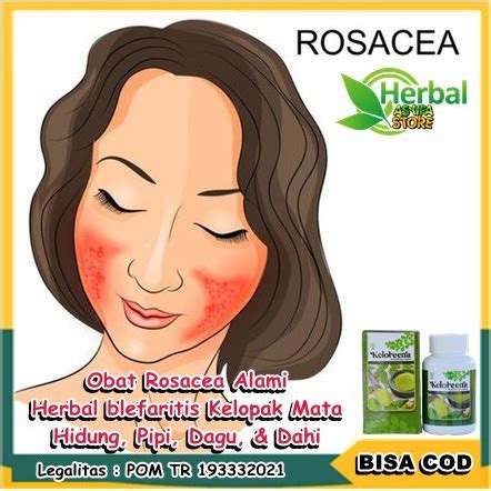 Jual Obat Rosacea Alami Herbal Blefaritis Kelopak Mata Hidung Pipi