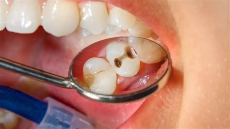 La Carie Dentaire Tout Savoir Sur Les Caries