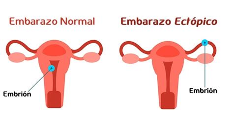 Embarazo Ectópico Signos Tratamientos Riesgos Y Síntomas