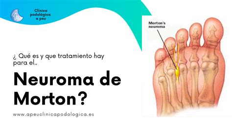 Qu Es Y Qu Tratamiento Existe Para El Neuroma De Morton Cl Nica