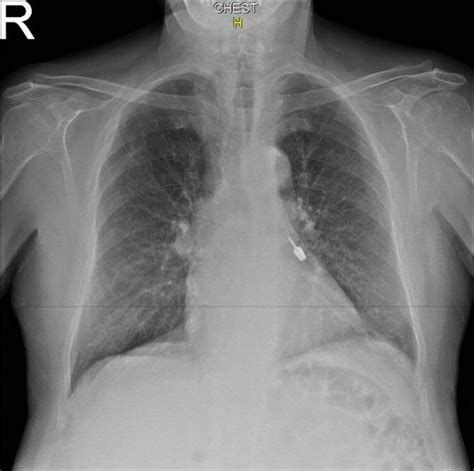 A Posterior Anterior Chest Radiography Showing Aspirated Screwdriver In