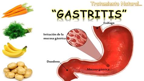 GASTRITIS TRATAMIENTO NATURAL REMEDIO CASERO NutriCiencia YouTube