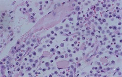 Skin: mastocytoma 01 - histopathology in Dogs (Canis) | Vetlexicon