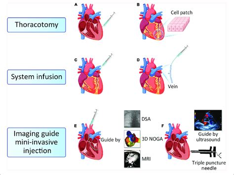 route  cell delivery  epicardial intramyocardial injection