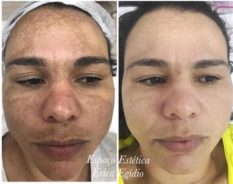 Portal Arcos Tratamento de Melasma e seus incríveis resultados