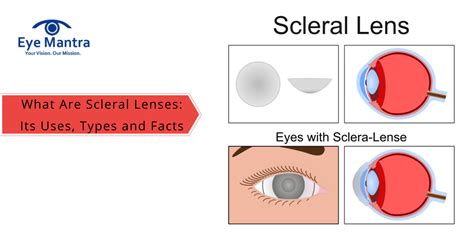 Scleral Lens For Dry Eyes Its Uses Types And Facts